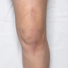Atténuation de cicatrice - Cabinet DERMA-PIGMENTA