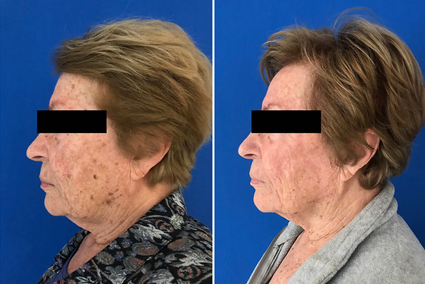 Tratamento Laser