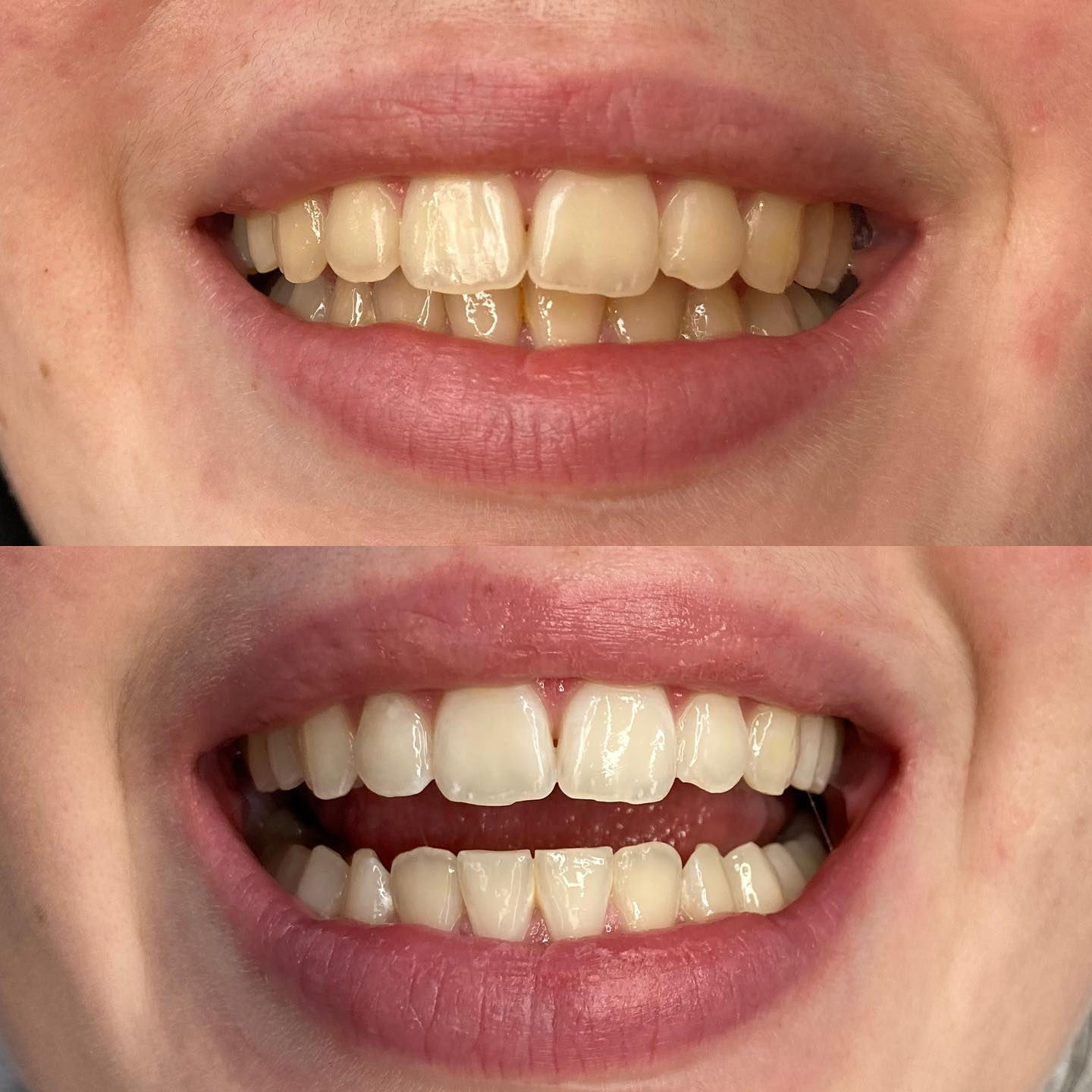 BLANCHIMENT DENTAIRE