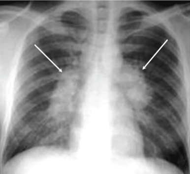 Tuberculosis x-ray clinmed