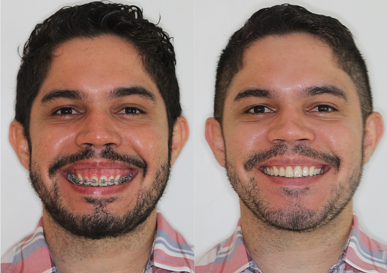 antes e depois caio.png