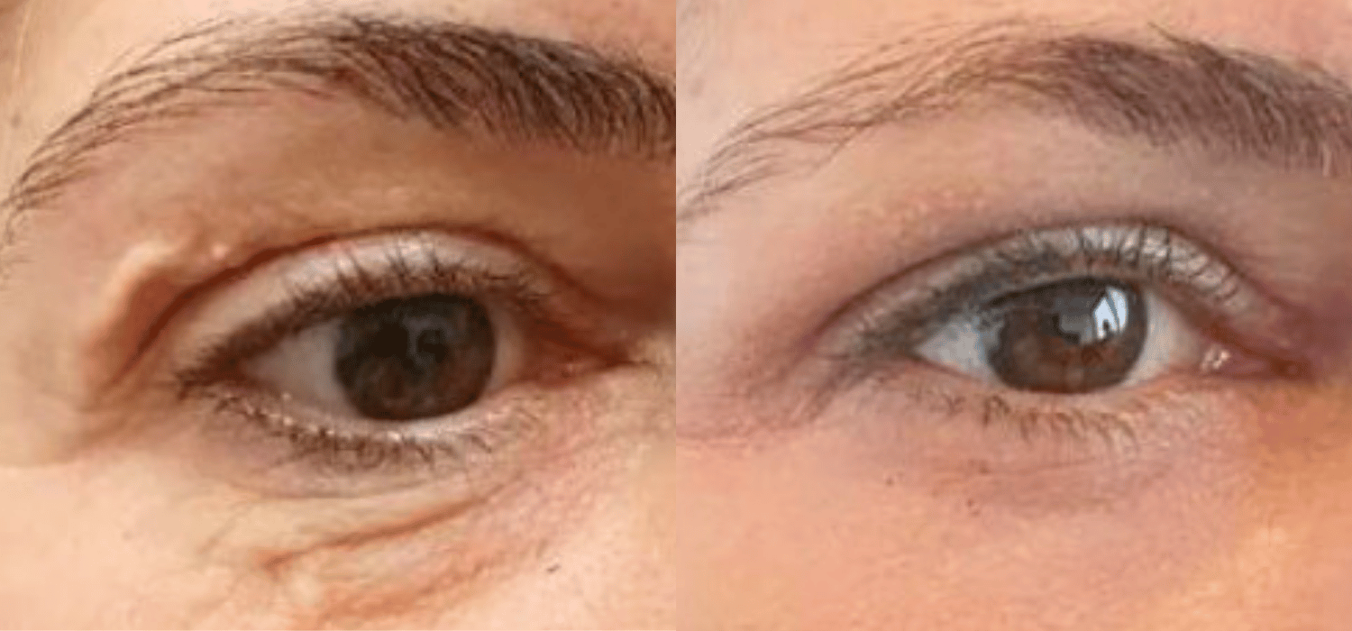 Non-Surgical-Blepharoplasty-Results-With-Plexr-Plus-Parsa-Wellness-Clinic-7