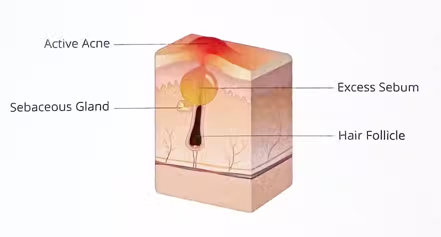 Skin cross section diagram showing laser energy penetrating the skin to target the sebaceous gland and collagen layer, illustrating regulation of excess oil production within the pore.