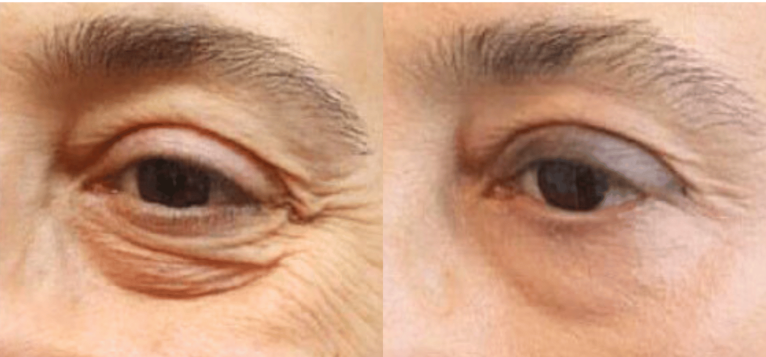 Non-Surgical-Blepharoplasty-Results-With-Plexr-Plus-Parsa-Wellness-Clinic-8
