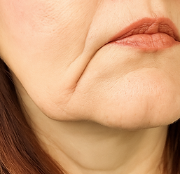Anti-wrinkle injections reducing marionette lines that extend from the corners of the mouth.