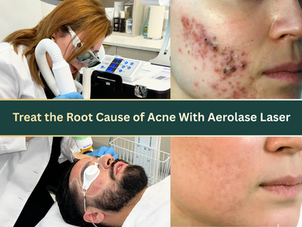 Aerolase laser treatment being performed on acne-prone facial skin in a clinical setting, illustrating a gentle, non-invasive approach to acne care.