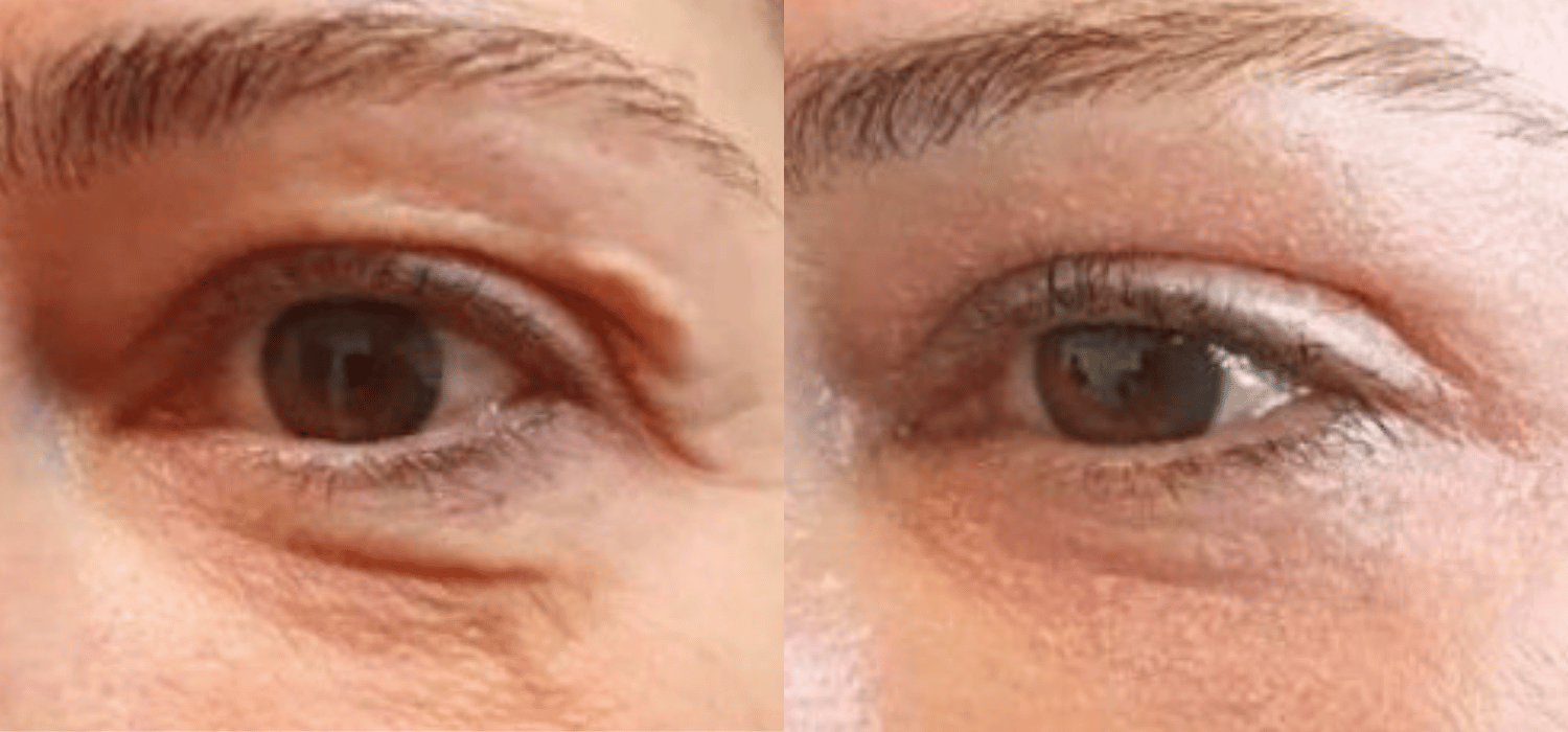Non-Surgical-Blepharoplasty-Results-With-Plexr-Plus-Parsa-Wellness-Clinic-5