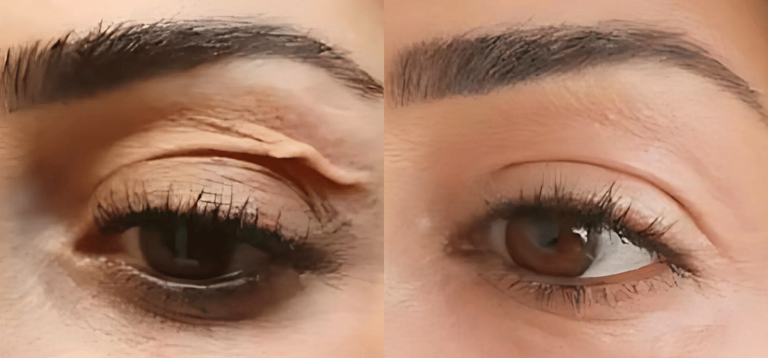 Non-Surgical-Blepharoplasty-Results-With-Plexr-Plus-Parsa-Wellness-Clinic-1