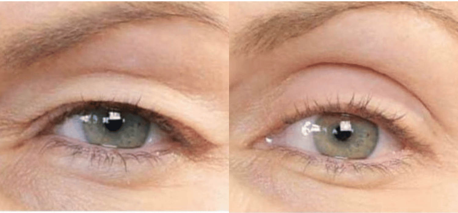 Non-Surgical-Blepharoplasty-Results-With-Plexr-Plus-Parsa-Wellness-Clinic-6