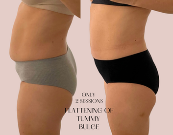Tone & Define Muscles with EMS Sculpt