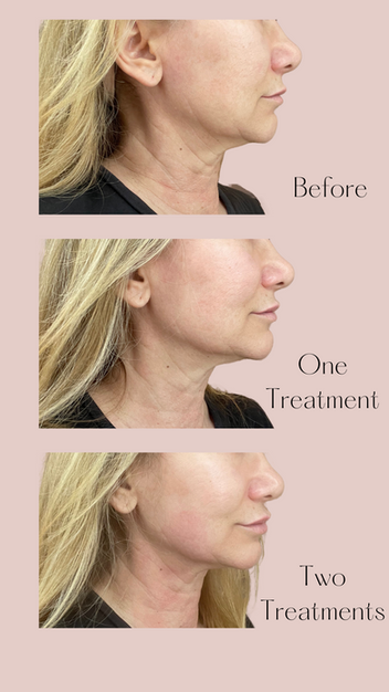 Jaw & Chin Contouring Before & After