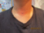Neck Dermal