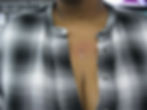Chest Dermal