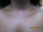 Neck Dermal