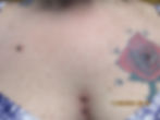 Chest Dermal
