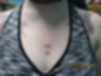 Chest Dermal