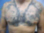 Chest Dermal