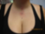 Chest Dermal