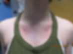 Chest Dermal