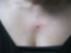 Chest Dermal