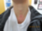 Neck Dermal