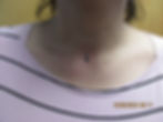 Neck Dermal