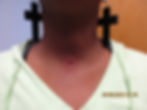 Neck Dermal