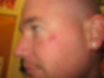Cheek Dermal