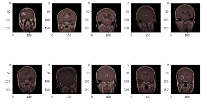 Tumor Classification.png
