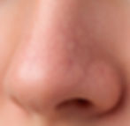 ThermaVein Thread Vein Removal