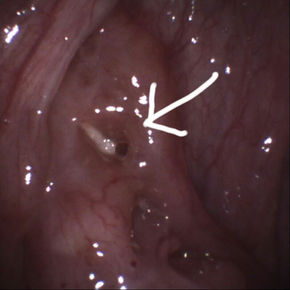How can I get my tonsils removed??