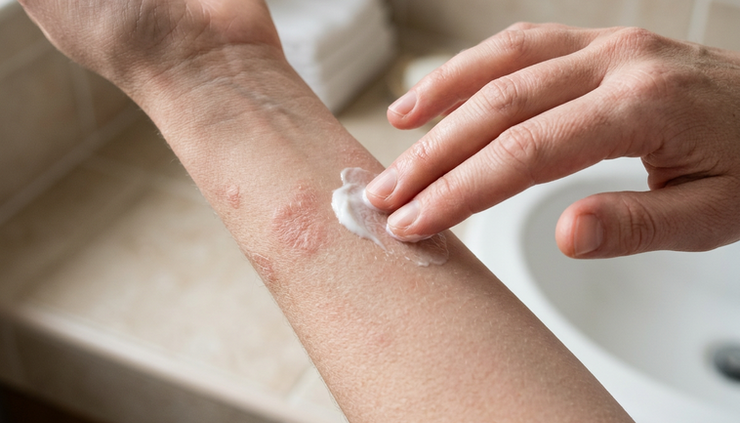 Close-up view of dry skin on a forearm being moisturized