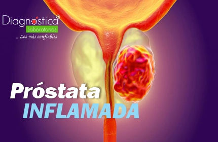 TENER PROSTATA INFLAMADA NO SIGNIFICA TENER CANCER