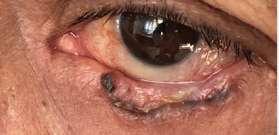 Tumor de párpado Mario Alberto Solorzano