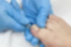 ongle-incarne.jpg