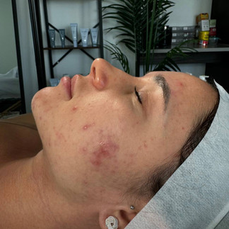 Girl with acne.  Improving. Second treatment