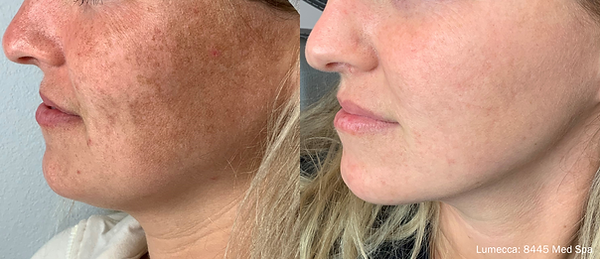 Lumecca Before & After - pigment .png