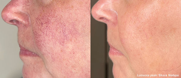 Lumecca - red veins before_after.jpg