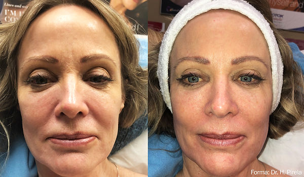 Forma_Before&After-9.jpg