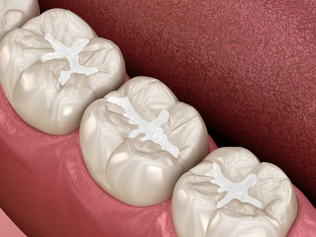 Dental Sealants: A Small Cost To Protect Your Teeth From Decay And Big Treatments