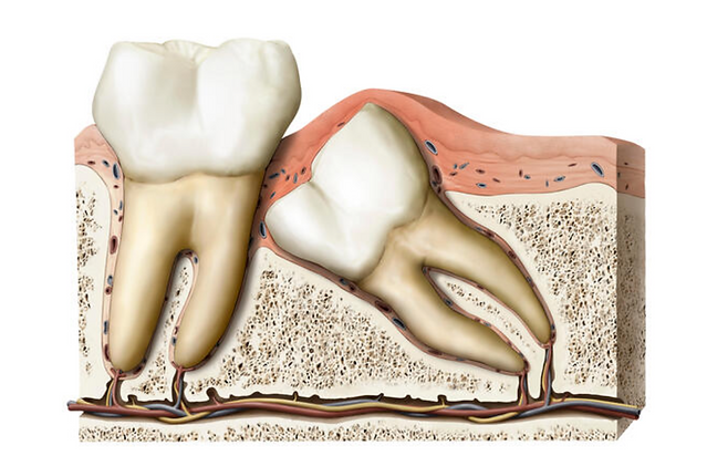 Wisdom Tooth Extraction at ConfiDent ® Palm Dentist - Facts You Need To Know.png