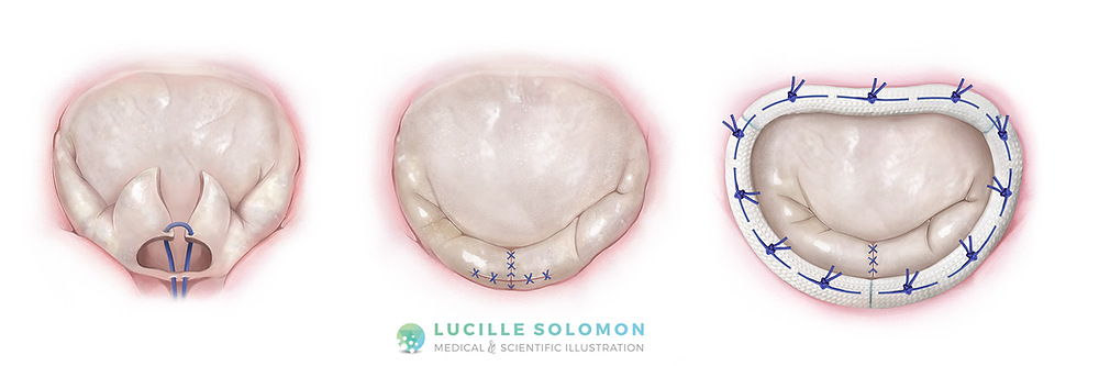 Mitral valve repair: triangular and butterfly resection, annuloplasty.