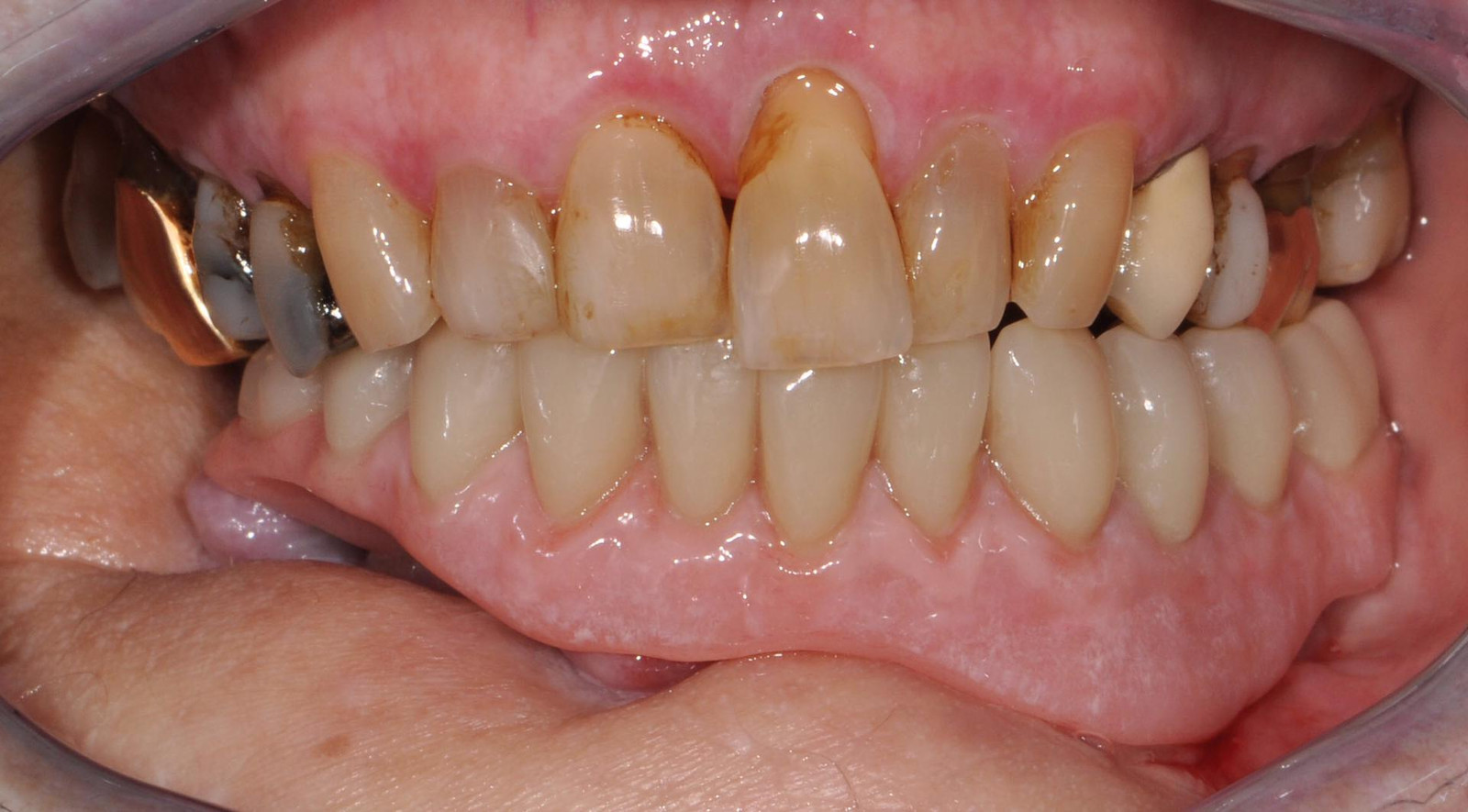 UK  Hybridprothese bei Tumorpatient