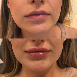 injectables + dermal fillers St Petersburg
