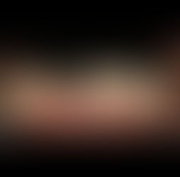 주조포스트를 이용한 반포치과 심미보철