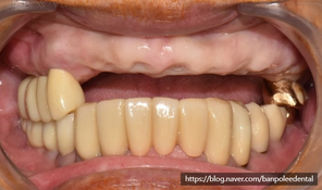 부분 무치악 부위에서 다수 임플란트를 통한 회복과 심미보철 Multiple implant palcement & esthetic restoration in partial edentulous area