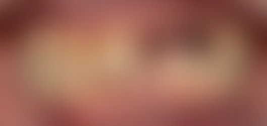 상악 전체 임플란트 수복 (발치 즉시 임플란트) (Mx. full mouth rehabilitation with immediate implant placement)