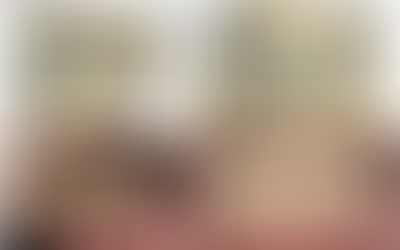 3D 디지털 가이드 임플란트 (Concept of computer guided implant placement)