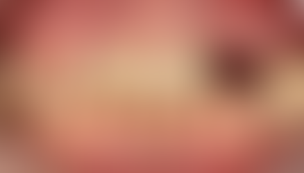 릿지스플릿 수평골증강술을 이용한 임플란트 식립(presentation of ridge split & implant placement, horizontal ridge augmentation)