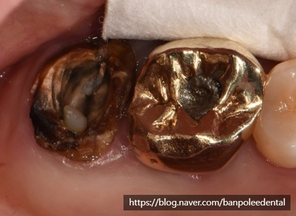 뿌리만남은치아 치관연장술 재신경치료 및 주조포스트 Crown lengthening, Re-endo Tx. & cast post crown 